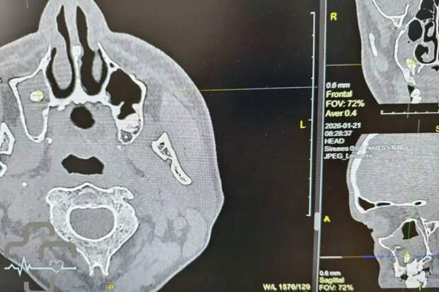 В носу жителя Оренбургской области нашли зуб