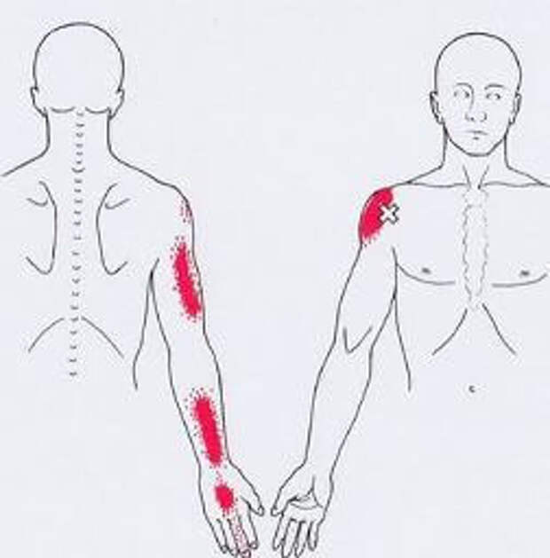 Карта триггерных точек человека и отраженных болей
