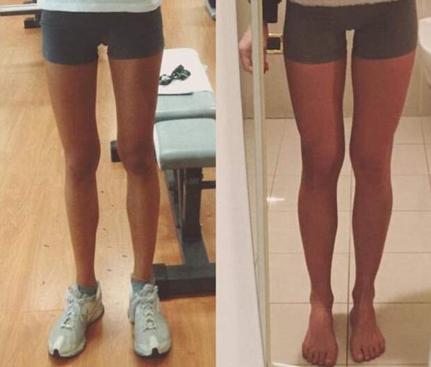 Итальянка вылечилась от анорексии благодаря Instagram Instagram, анорексия, фигура