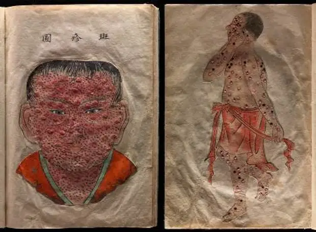 Медицинские болезни и состояния, увековеченные в произведениях искусства