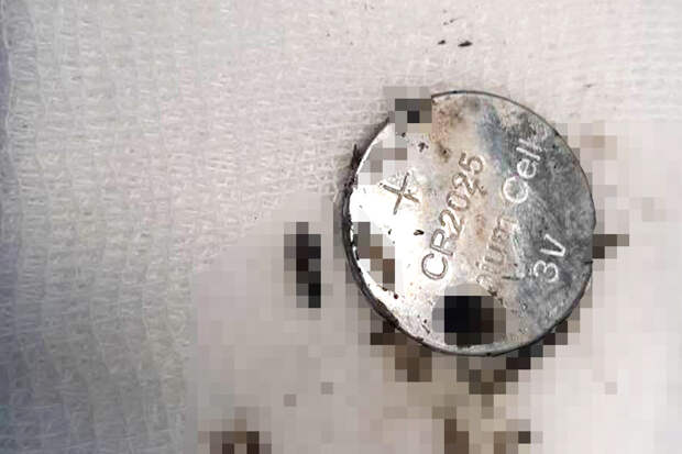 В Липецке спасли двухлетнюю девочку с лопнувшей в пищеводе батарейкой