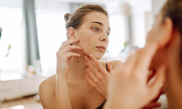 Дерматолог Евгения Даниленко: с акне сталкиваются около 40% людей старше 25 лет