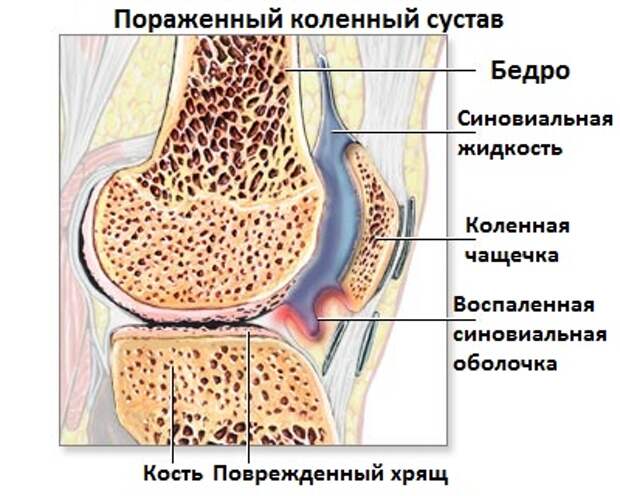 Пауциартикулярный юношеский артрит: лечение, симптомы и профилактика