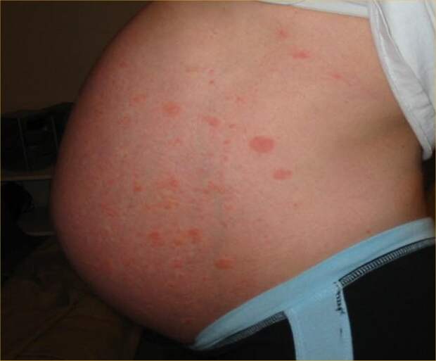 wpid-httpwwwhealthtipsandguidesnetwp-contentuploads201104Pruritic-urticarial-papules-and-plaques-of-pregnancy7