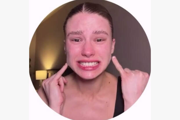 Девушка показала лицо неестественной формы после ботокса