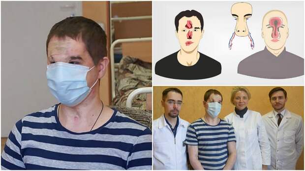 Первая операция по пересадке лица в России операция, пересадка органов, трансплантология