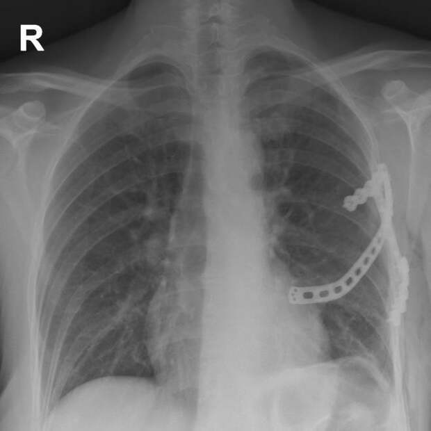 В ФГБУ «Национальный медицинский исследовательский центр фтизиопульмонологии и инфекционных заболеваний» Минздрава России обратилась женщина с жалобами на выпячивание в области грудной клетки при дыхании и кашле. Подробности узнала «Медицинская Россия». Симптомы появились спустя несколько лет после удаления 4-го ребра слева из-за доброкачественной опухоли. Со временем жалобы усиливались и начали приносить ей дискомфорт.