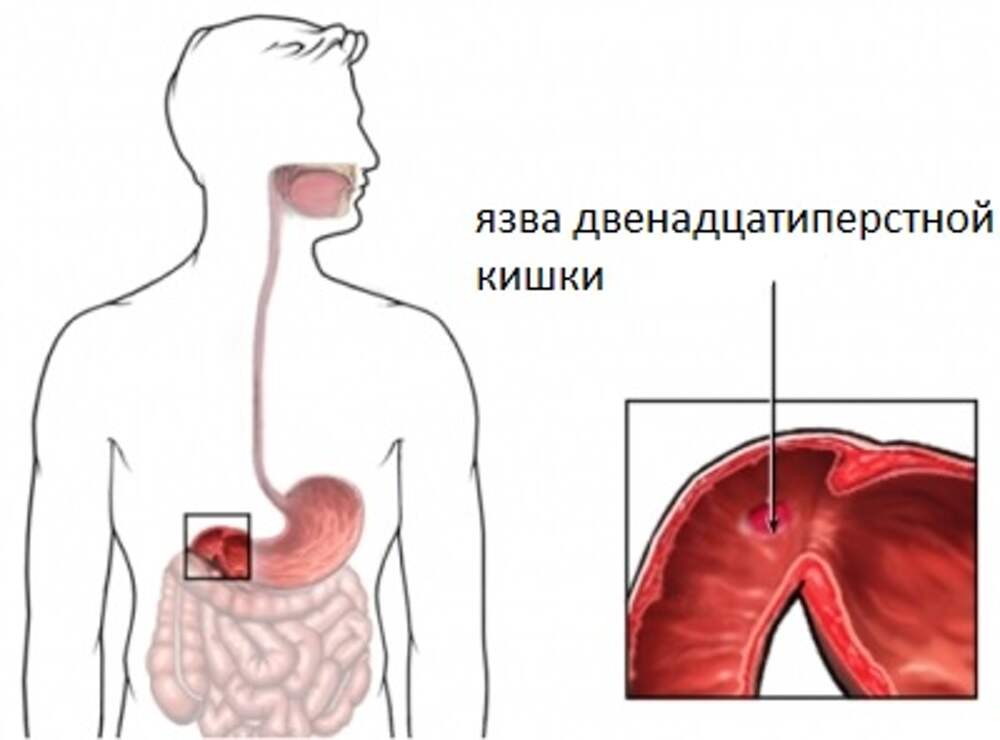 Язвенная болезнь 12 перстной кишки картинки