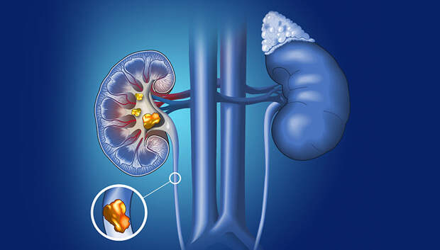 Раскрыта истинная причина образования камней в почках