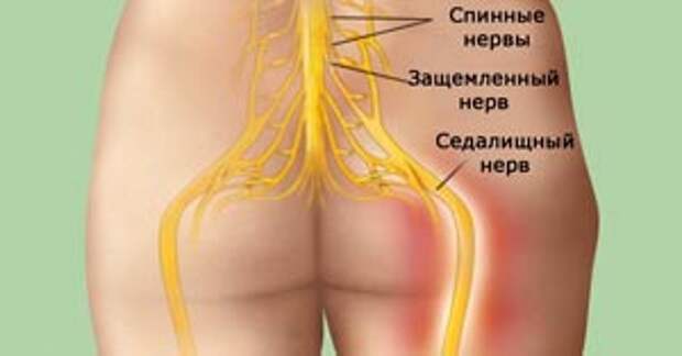 Лечение седалищного нерва