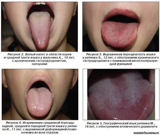 Диагностика болезней по языку