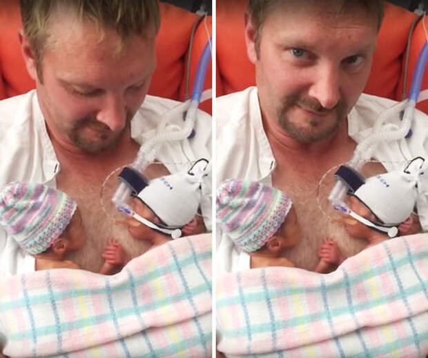 Недоношенные близнецы, держащиеся за руки, покорили интернет  близнецы, история, рождение