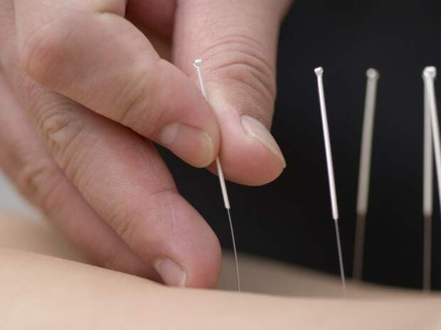 http://yesmoke.eu/wp-content/uploads/2010/02/xacupuncture-526x394.jpg.pagespeed.ic.QgeHkvR8II.jpg