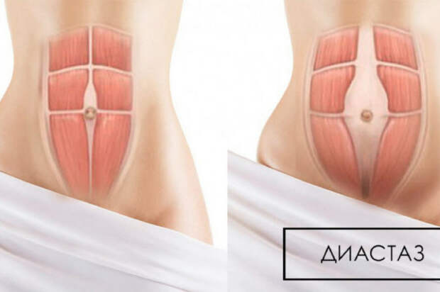 Упражнения от диастаза, от обвисания живота для женщин.