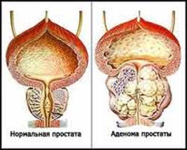 prostata