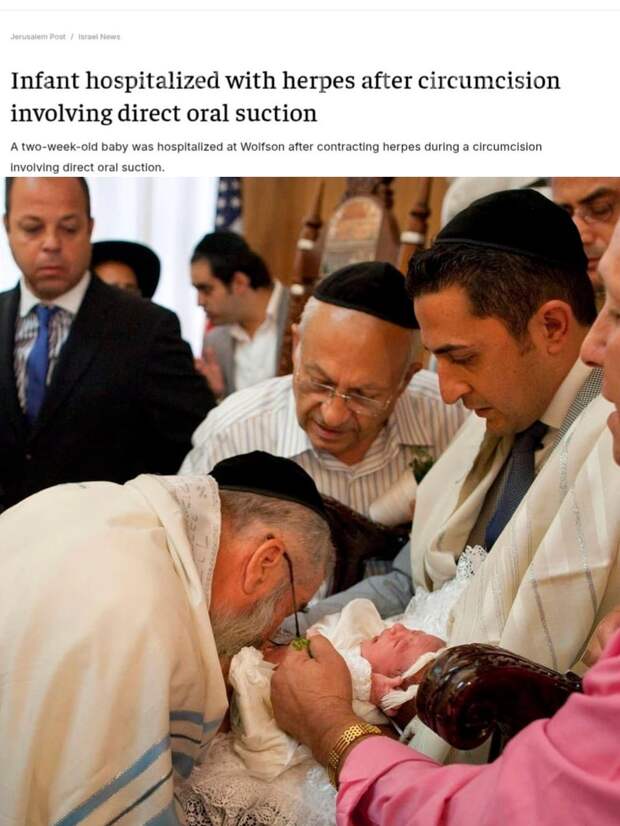 Израильский раввин отсосал у младенца кровь из ранки на пенисе — ребёнок заразился герпесом и попал в реанимацию, пишет The Jerusalem Post.