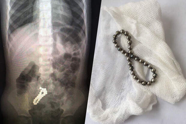 В Подмосковье врачи спасли ребенка, наглотавшегося магнитов