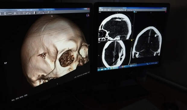 Сутки с пулей в голове: нейрохирурги спасли пациента с уникальным ранением