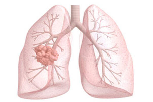 метастазы в легких