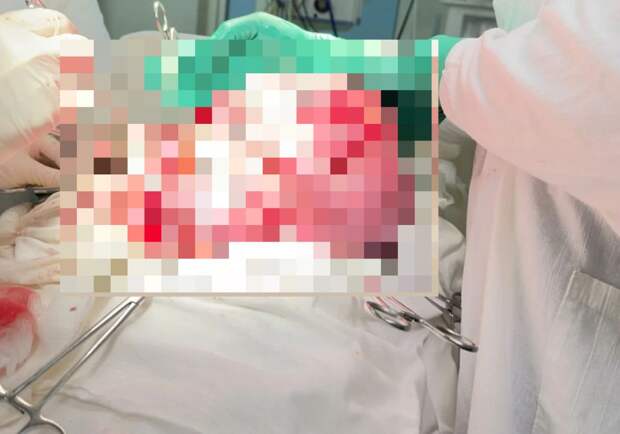 В Туле врачи удалили 44-летней женщине миому матки весом более 14 кг