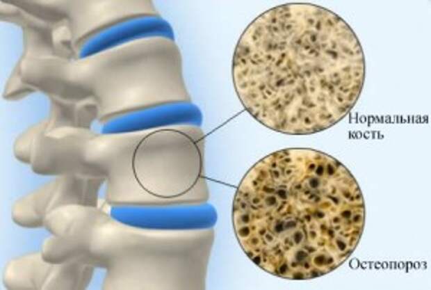 Истинные причины развития остеопороза