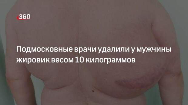 Подмосковные врачи удалили у мужчины жировик весом 10 килограммов