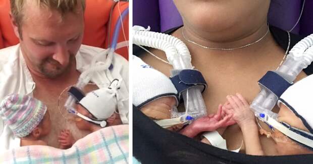 Недоношенные близнецы, держащиеся за руки, покорили интернет  близнецы, история, рождение