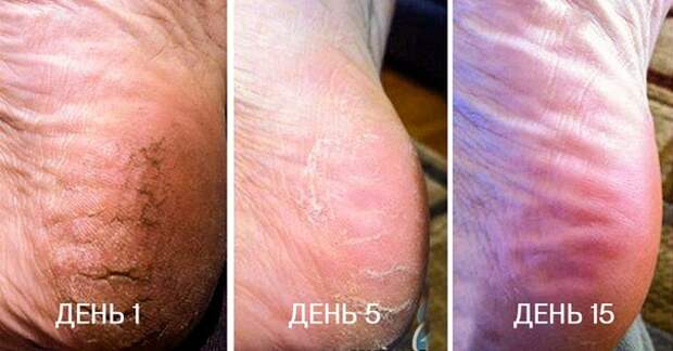 Первоклассное средство против трещин на пятках: смешай 2 ингредиента и забудь о проблеме! Первоклассное средство против трещин на пятках: смешай 2 ингредиента и забудь о проблеме!