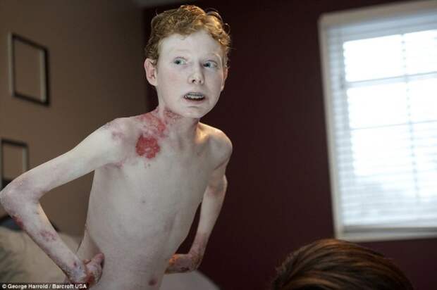 Четырнадцатилетний канадец Джонатан Питр страдает врождённым буллёзным эпидермолизом. Его кожа настолько чувствительна, что отслаивается при малейшем механическом воздействии.