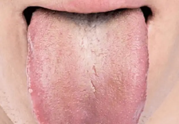 Что расскажет язык о вашем здоровье