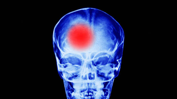 Врач Копцева: курение и нездоровая еда повышают риски инсульта