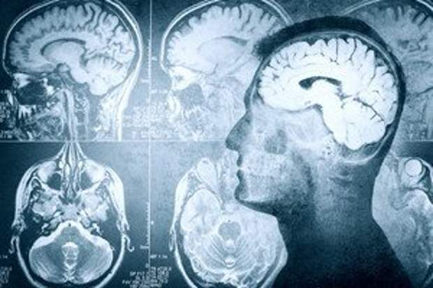 is-brain-death-reversible-3