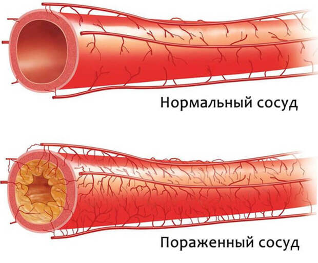 Доказано: отказ от животного белка лечит атеросклероз