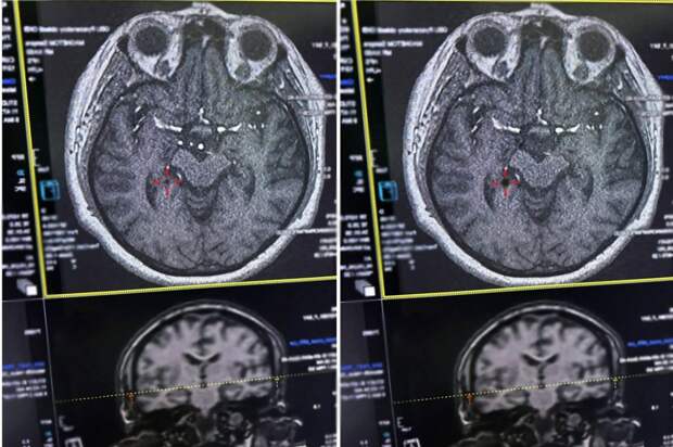 В Рязани врачи областной клинической больницы оперативно спасли женщину с инсультом