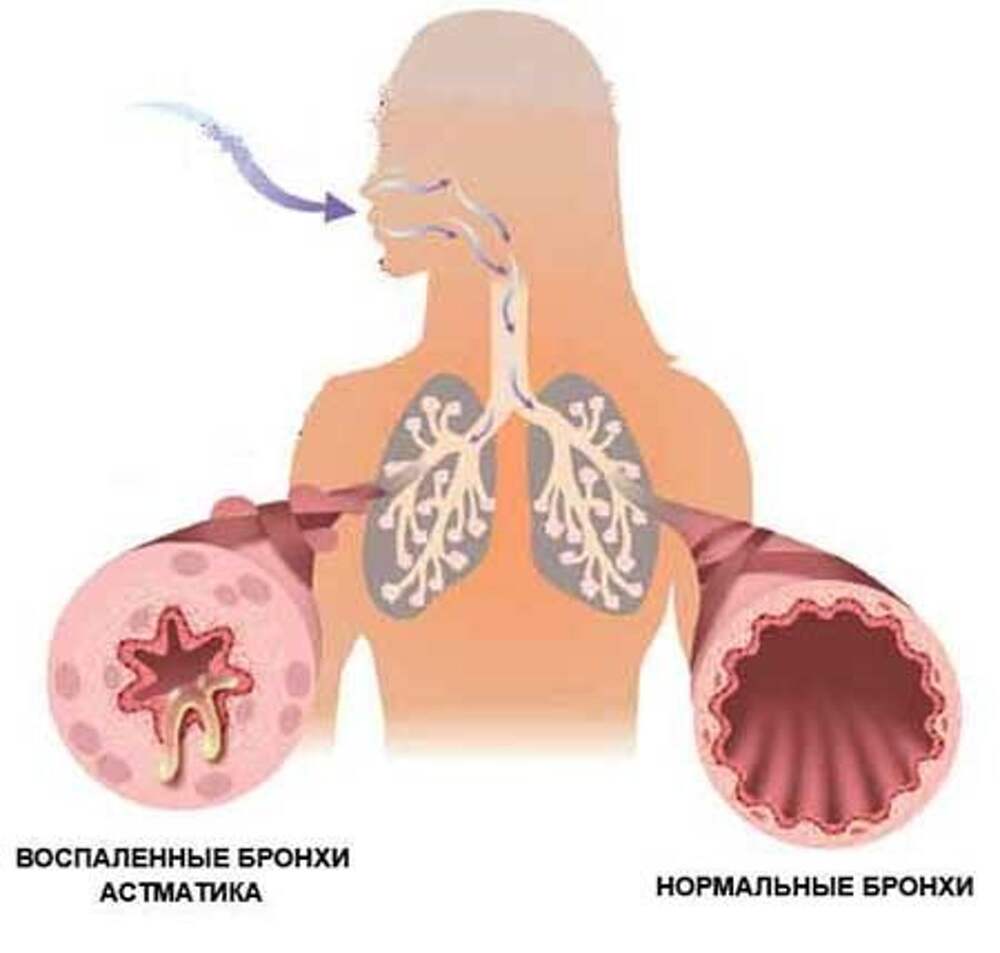Bronchial asthma. Бронхиальная астма патология. Бронхиальная астма астматический статус. Бронхи при бронхиальной астме. Астма легкие.