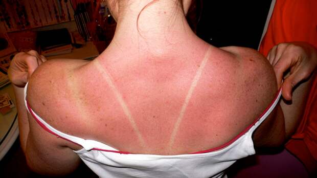 sunburn-on-back-610x343