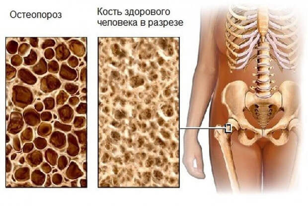 Что такое остеопороз? Исследования ученых и скрытые факты данной проблемы. Пути к профилактике возникновения остеопороза