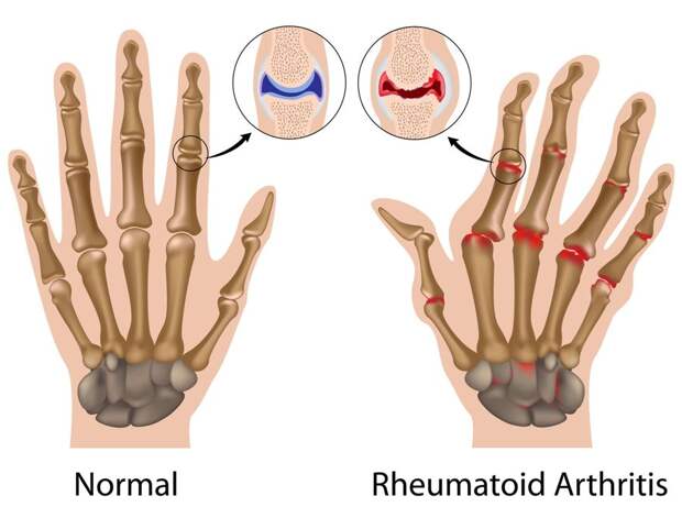 Arthritic hands