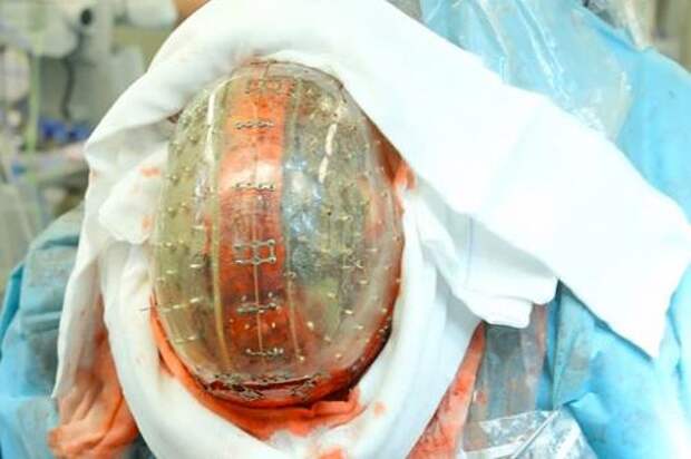 Пластиковый череп напечатали на 3D-принтереГолландские хирурги заменили женщине почти целый череп на пластиковый имплантат, напечатанный на 3D-принтере. Этим они избавили ее от тяжелых последствий редкого генетического заболевания.