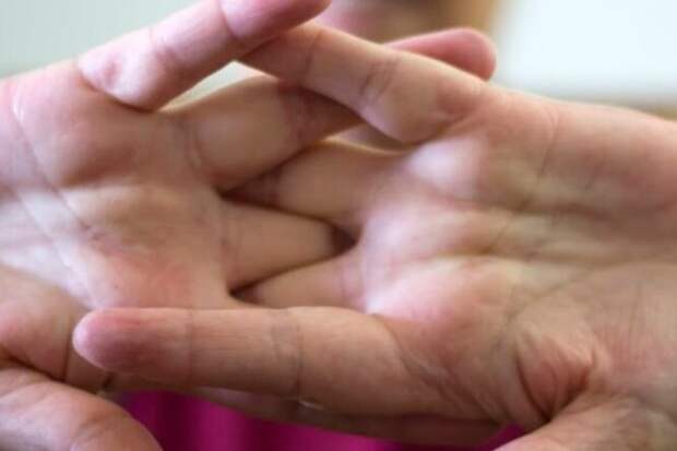 Крепитация: почему хрустят суставы и опасно ли это?