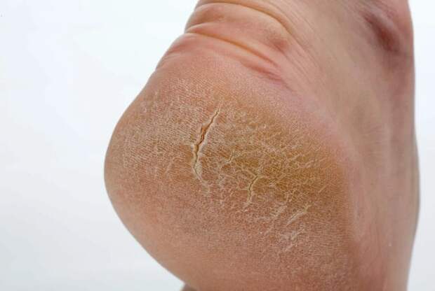 Мгновенно убирает трещины на пятках