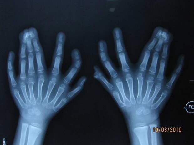 рентгену 120 лет, самые интересные рентгеновские снимки, шокирующие рентгеновские снимки