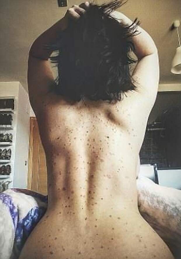 Psoriasis Porn