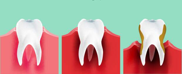 6 вопросов стоматологу о воспалении десен