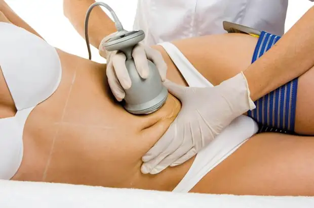 Cavitație abdominală cu ultrasunete