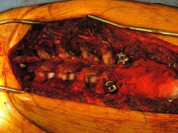 Сильная девушка до, во время и после операции на позвоночнике (14 фото)