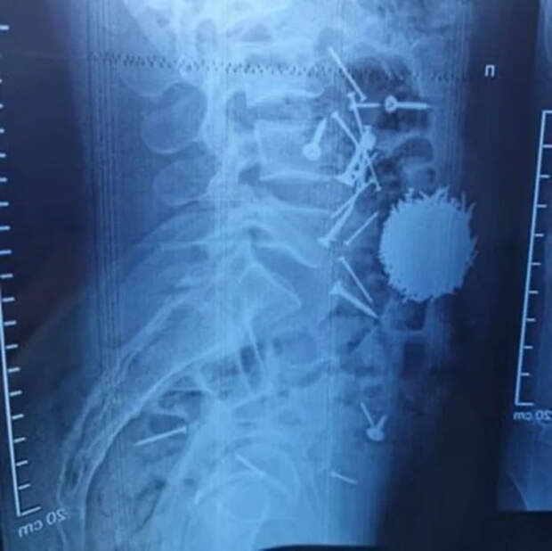 Невероятная история из Узбекистана: 200 граммов гвоздей и саморезов извлечены из желудка мужчины