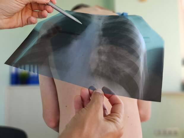 Онколог опроверг миф о срочности лечения рака