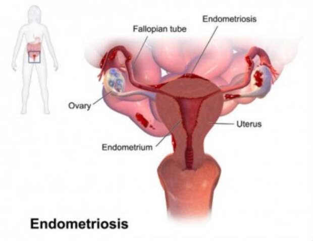 endometriosis-610x471