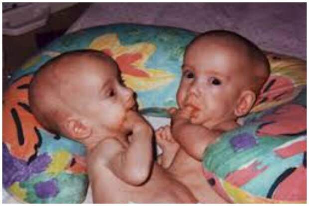 Emily и Caitlin Copeland близнецы сиамские, бывает же, выросли, жизнь, интересное, разделили